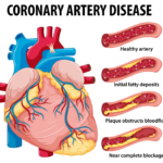 -enfermedad arterial coronaria_