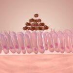 gonorrea