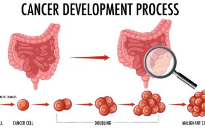 El cáncer anal aumenta en España y revela desigualdades según el territorio y el sexo