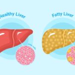 Hígado graso, esteatosis