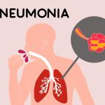 Neumonía. Imagen: Freepik