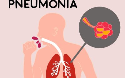 Uso racional de antibióticos en la neumonía adquirida en la comunidad en personas con el VIH