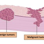 lesión cancerígena