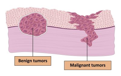 El tratamiento precoz de lesiones anales reduce el riesgo de cáncer en personas con el VIH