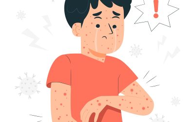 La expansión del sarampión en EE UU pone en riesgo a personas con el VIH inmunodeprimidas