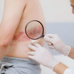 Herpes zóster. Culebrilla. Imagen: Freepik