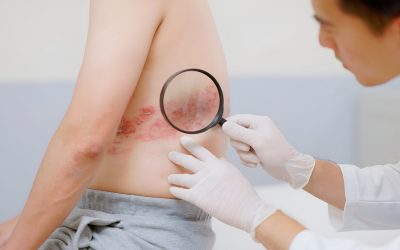 El herpes zóster sigue siendo más frecuente en personas con el VIH pese a los avances terapéuticos
